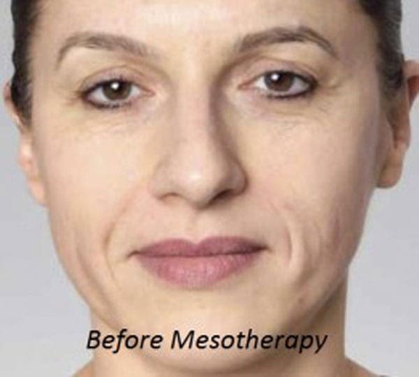 mesotherapy treatment before