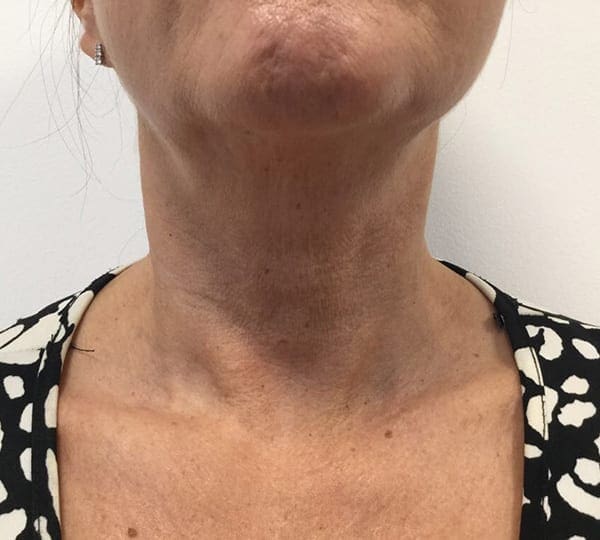 mesoteraphy treatment after