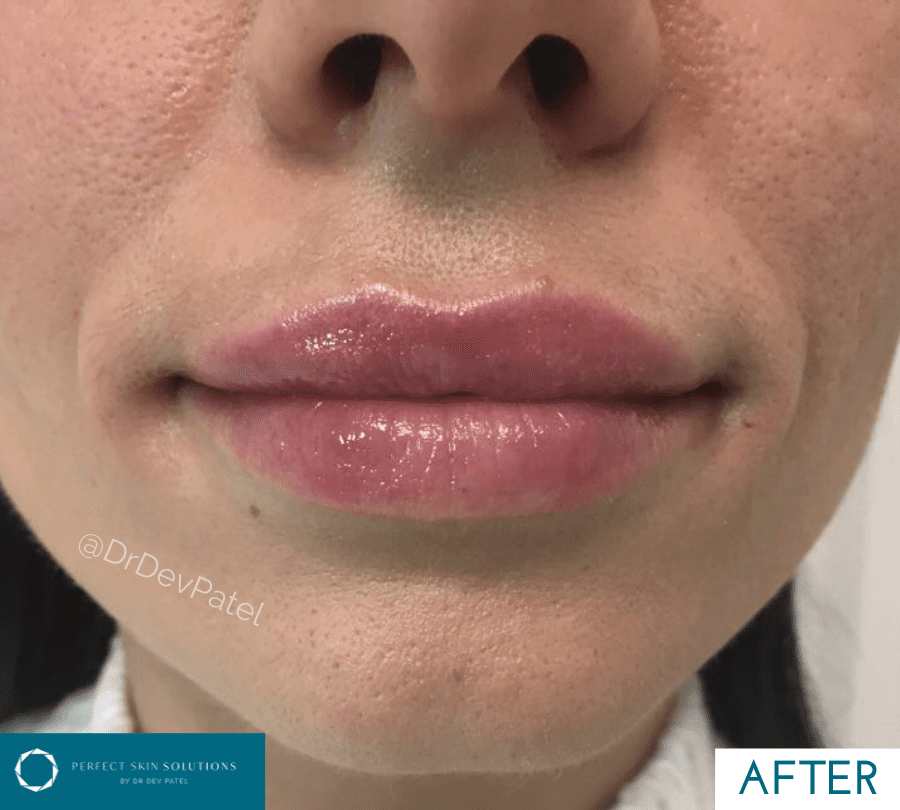 Lip fillers are a very popular treatment at Perfect Skin Solutions