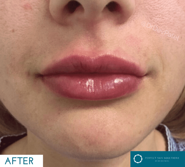 Lip filler is a great treatment