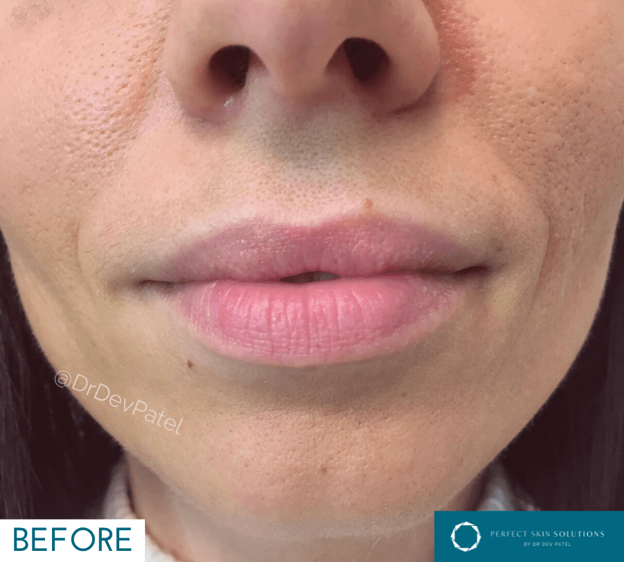 Lip fillers are a very popular treatment at Perfect Skin Solutions