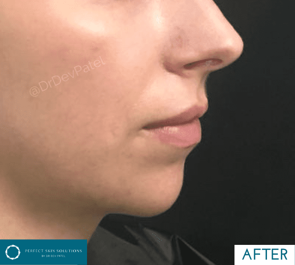 chin filler treatment after