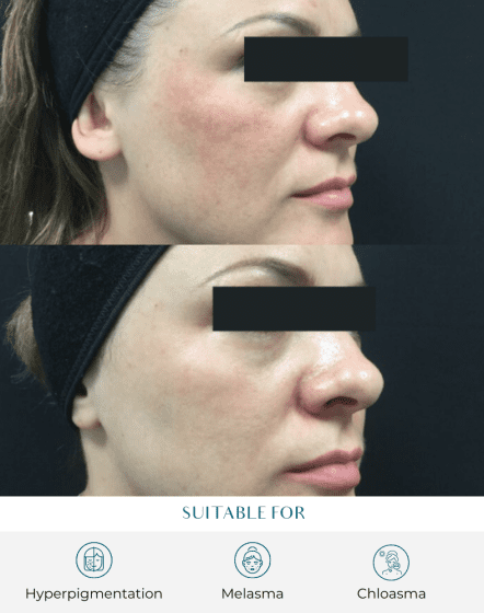 melasma protocol