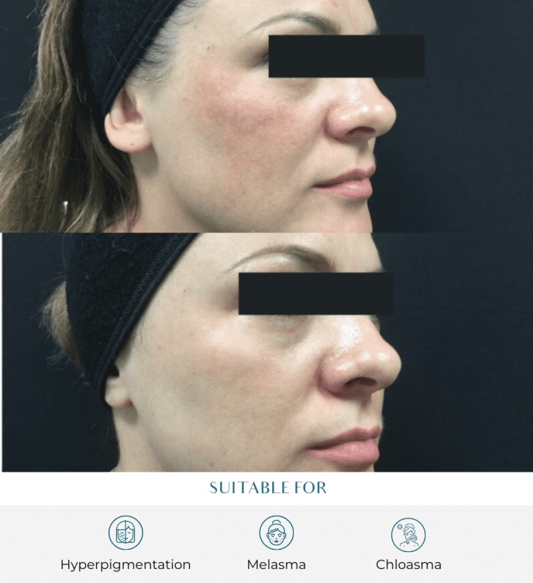 melasma protocol