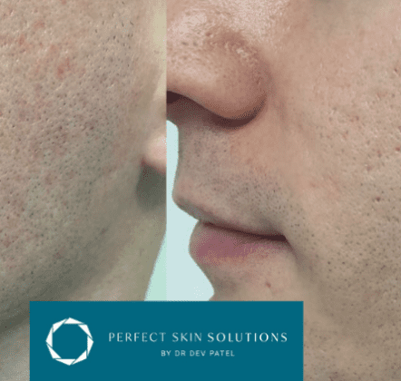 Facial for Scars: Acne Scar Treatments at Perfect Skin Solutions