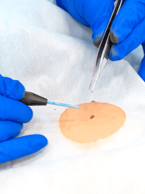 skin surgery being performed