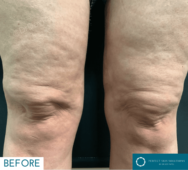 endolift treatment