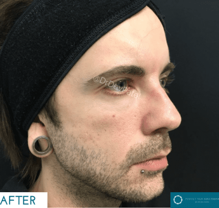 Jawline Fillers Men: Achieve a Strong, Defined Jawline with Dermal Filler Treatments
