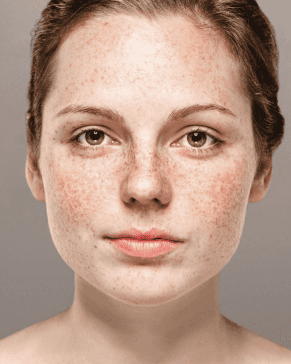 How to Get Rid of Red Pimples on Face: A Complete Guide