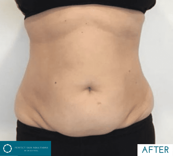 fat reduction treatment after