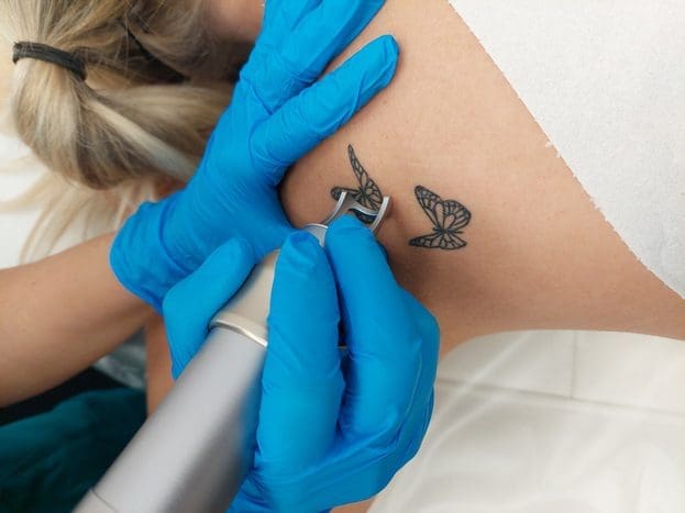 tattoo removal