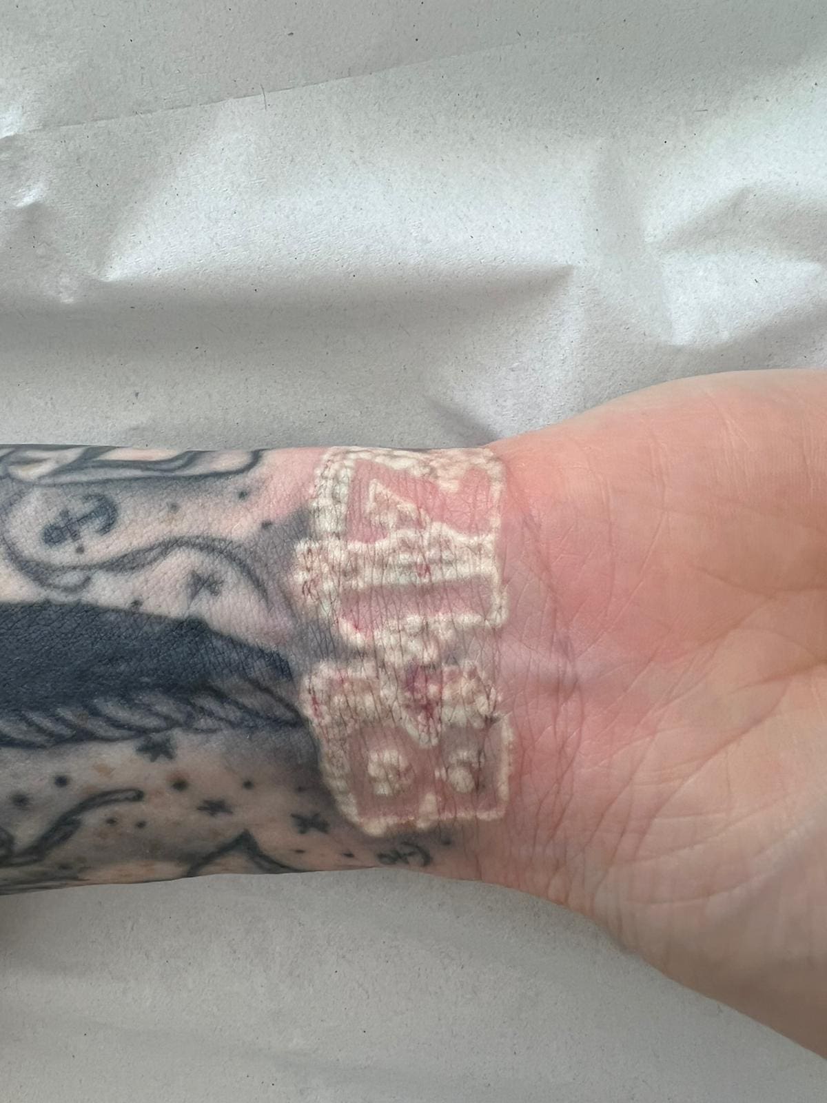 healing after laser