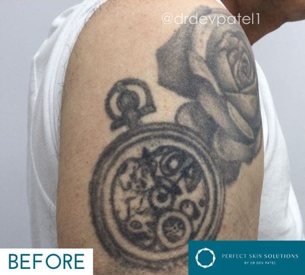 Picomax Laser Treatment for Dark Ink Tattoo Removal