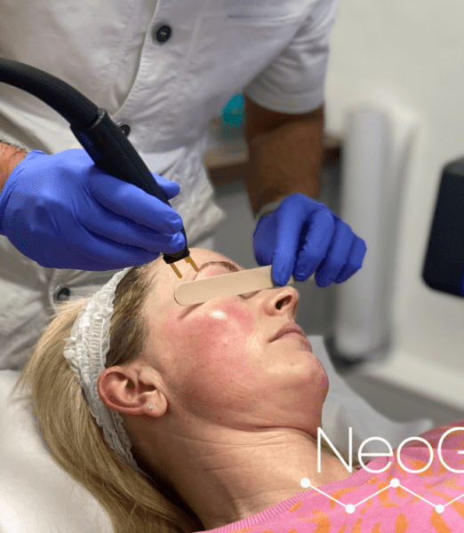 NeoGen PSR at Perfect Skin Solutions Portsmouth