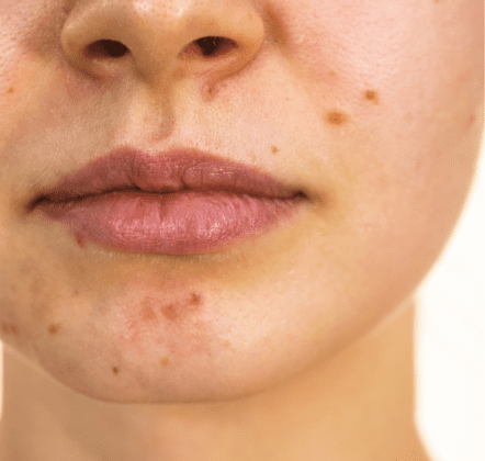 Private Skin Tag Removal