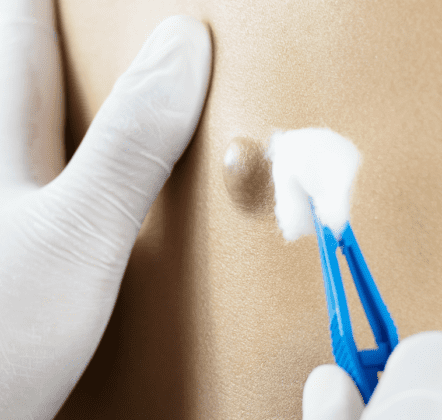 Private Cyst Removal: A Guide