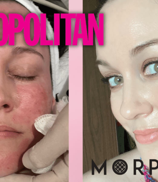 I had the celeb fav Morpheus8 treatment and I want to talk about the pain
