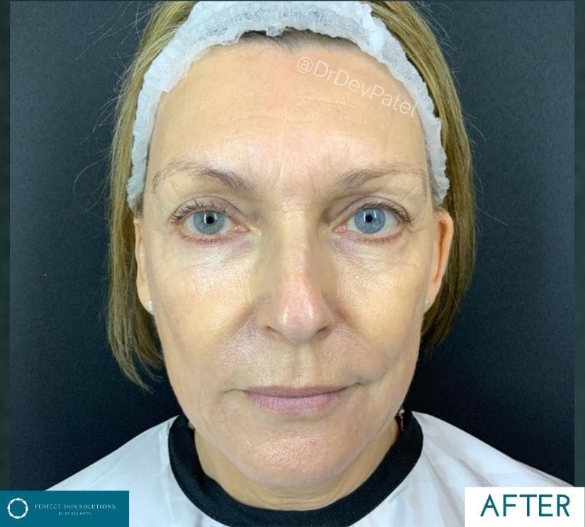 sofwave treatment after