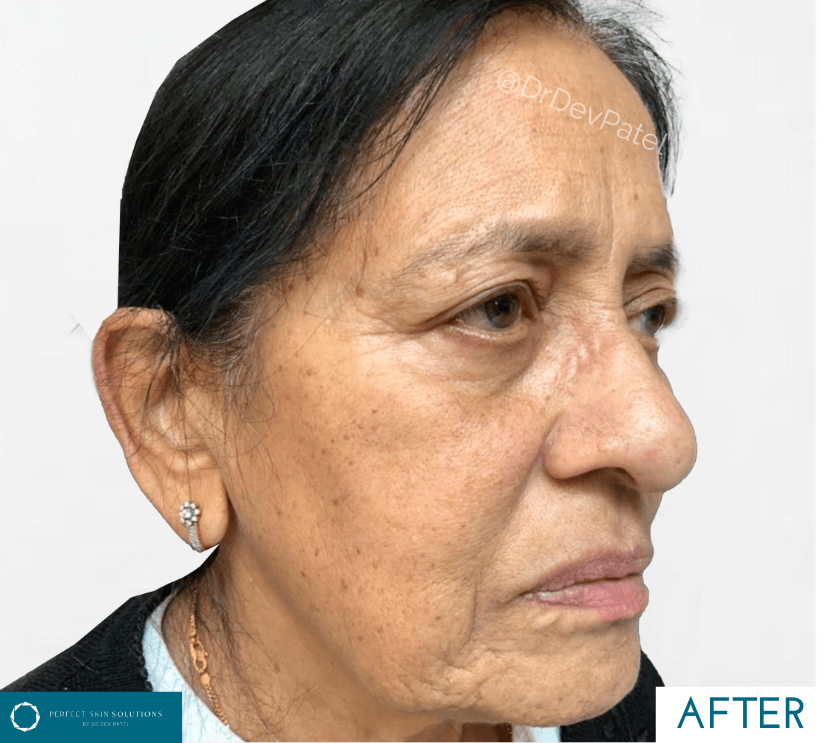 Sofwave treatment after