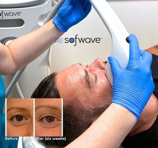 sofwave treatment banner