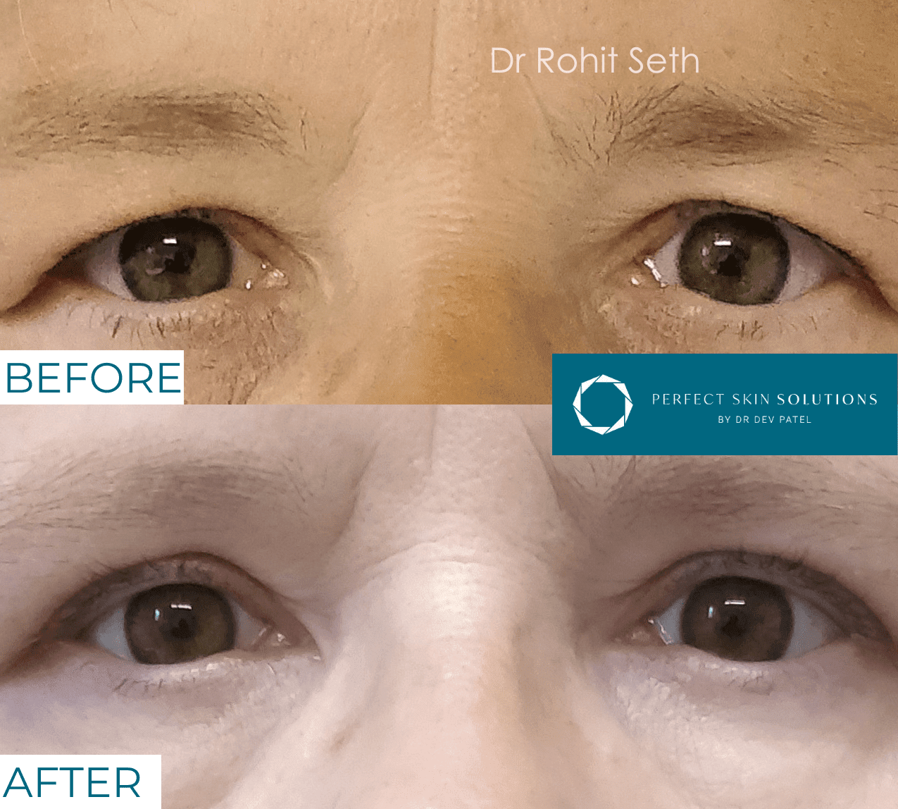 Before and after photo of eyes from blepharoplasty eyelid surgery man