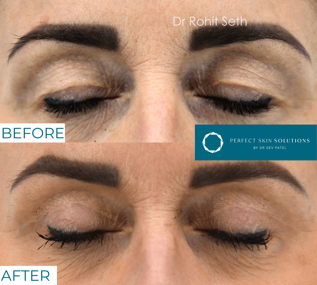 Before and after photo of eyes from blepharoplasty eyelid surgery woman eyes closed