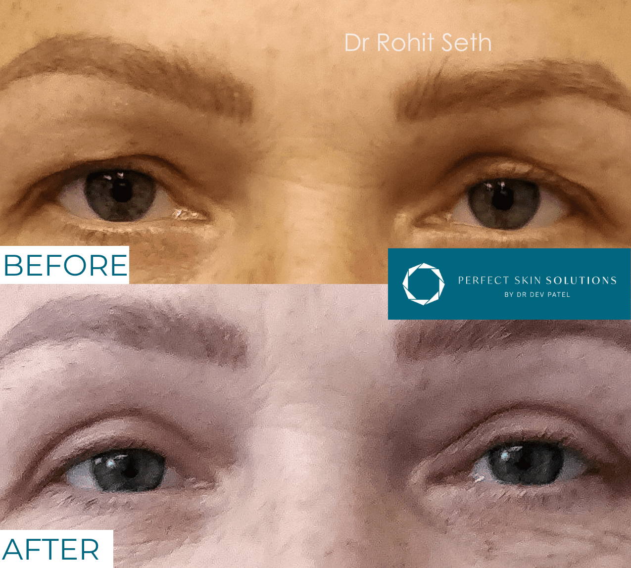 Before and after photo of eyes from blepharoplasty eyelid surgery woman