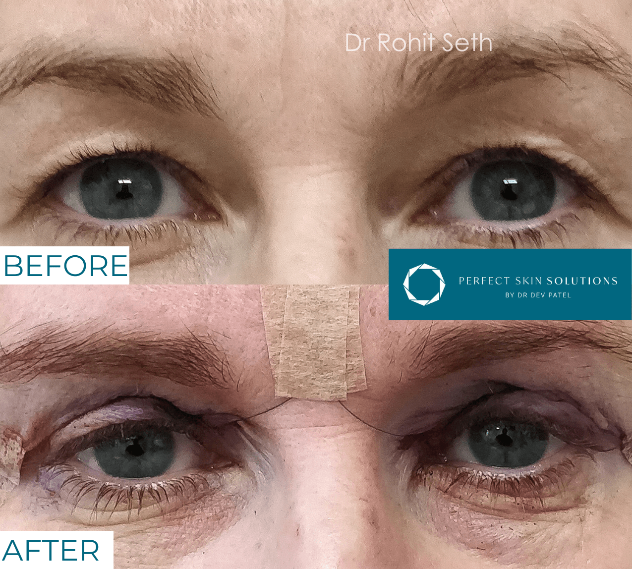 Before and a few days after photo of eyes from blepharoplasty eyelid surgery woman