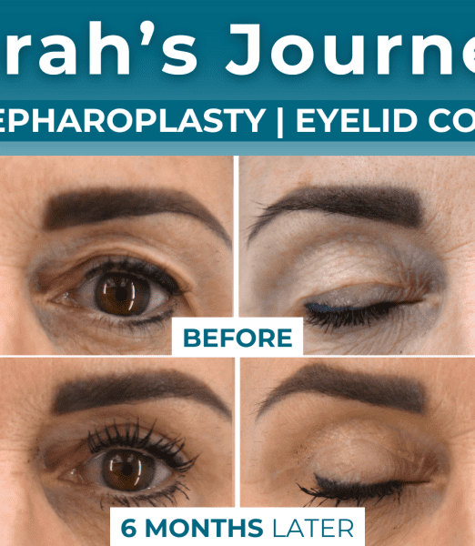 Sarah’s Journey | Upper Blepharoplasty Eyelid Correction