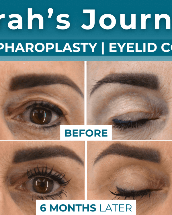 Sarah’s Journey | Upper Blepharoplasty Eyelid Correction