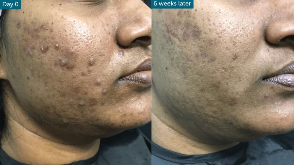 before and after acne patient