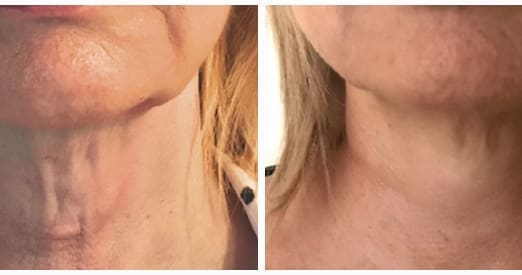 Ultimate Guide to Treating Wrinkly Neck Skin: Solutions for a Youthful Neck