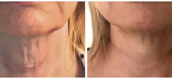 Ultimate Guide to Treating Wrinkly Neck Skin: Solutions for a Youthful Neck