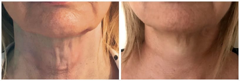 neck lift treatment