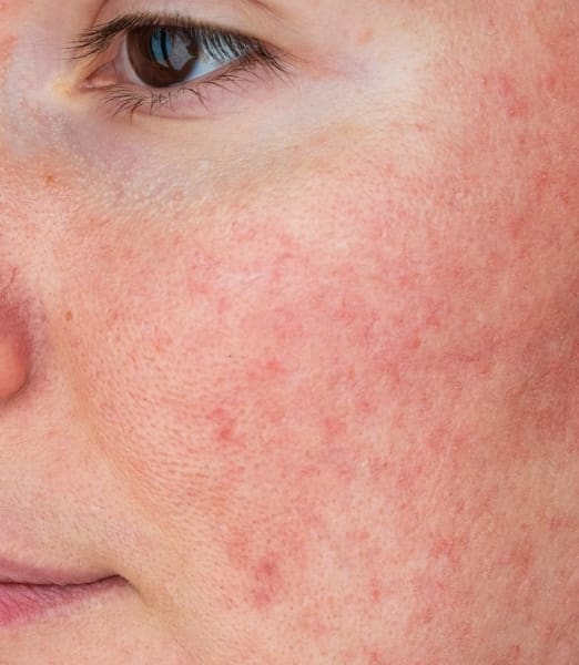 How to Treat Rosacea Redness: Effective Solutions for Sensitive Skin