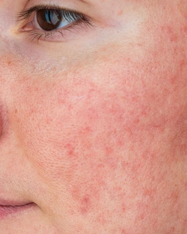 How to Treat Rosacea Redness: Effective Solutions for Sensitive Skin