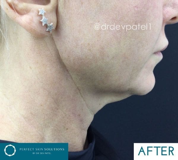 endodefine after