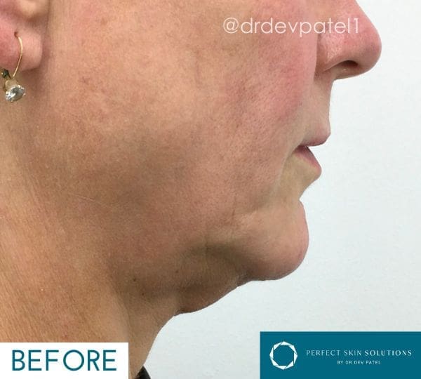 endodefine before