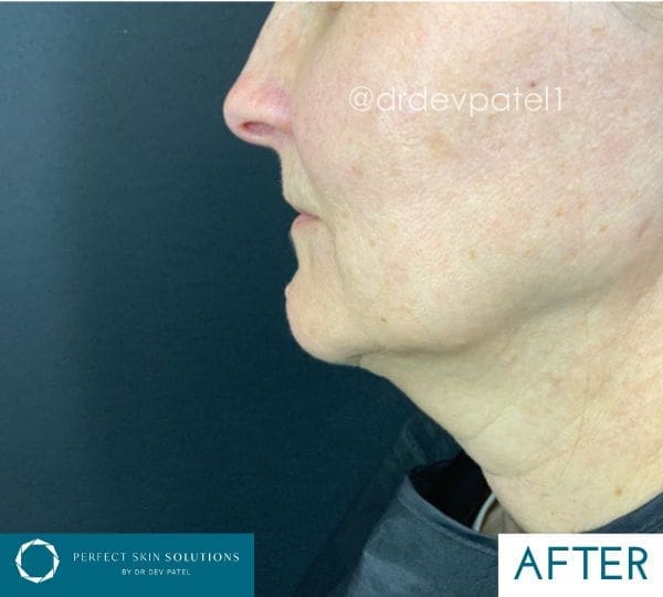 endodefine results