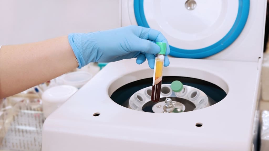 platelet rich plasma treatment