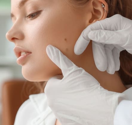 Facial Moles: What You Need to Know