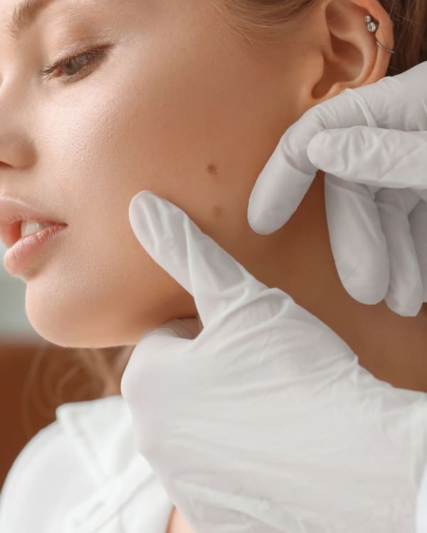 Facial Moles: What You Need to Know