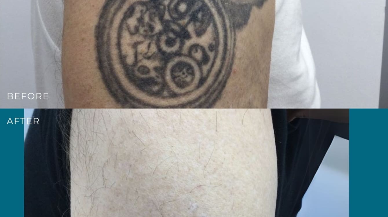 laser tattoo removal