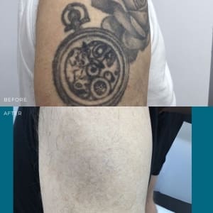 laser tattoo removal