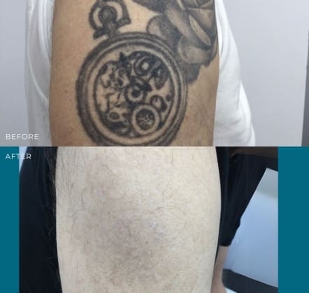 Understanding Laser Tattoo Removal Cost: What to Expect and Factors Involved