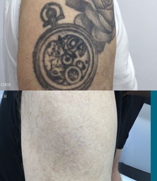 Understanding Laser Tattoo Removal Cost: What to Expect and Factors Involved