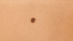 brown mole on skin