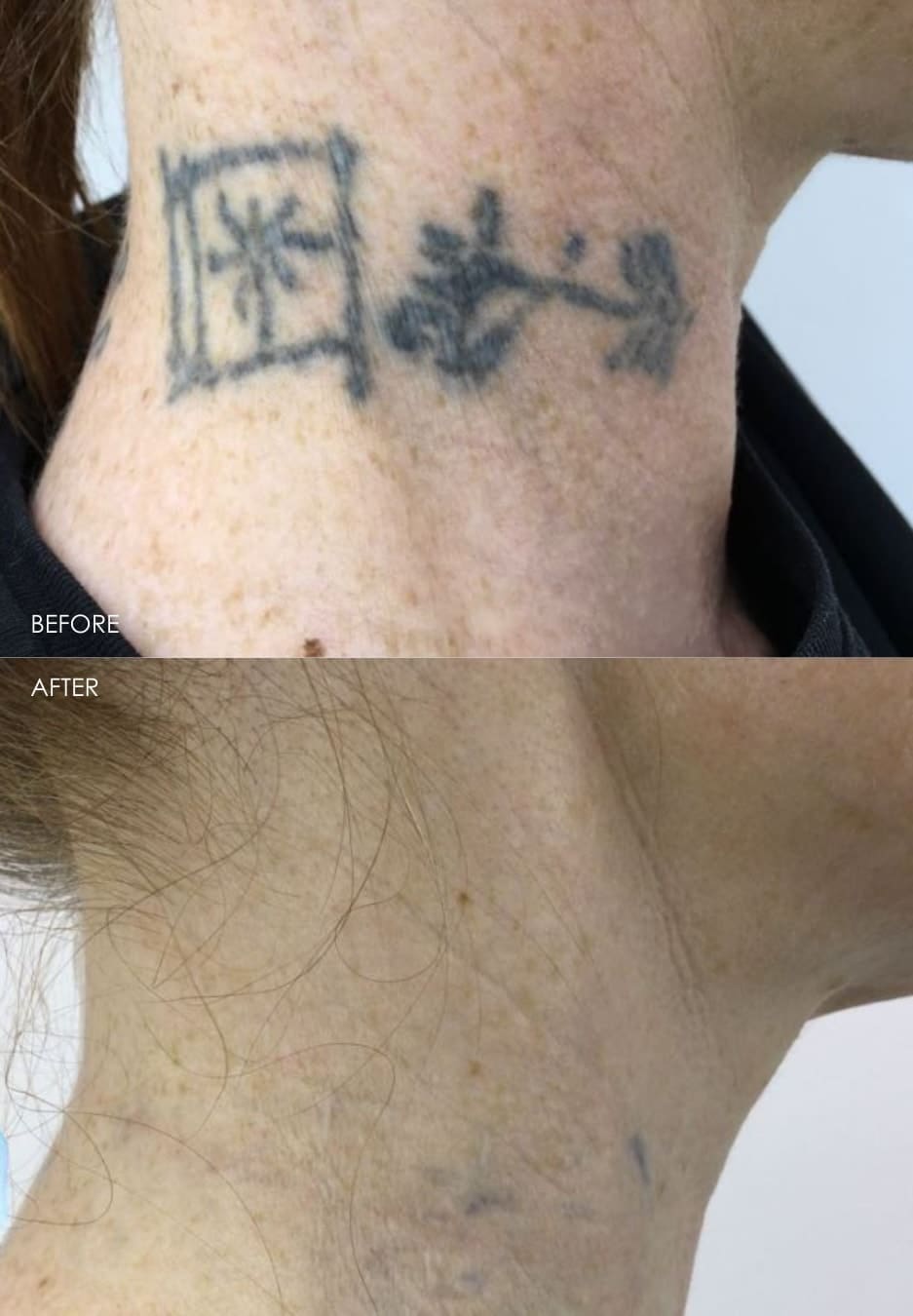 tattoo removal before and after